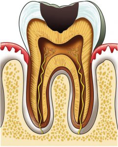 صحة الأسنان - مراحل تسوس الأسنان